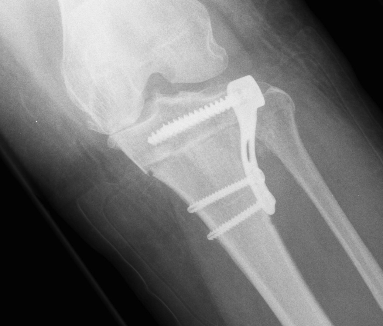 HTO Closing Wedge Medial Fracture